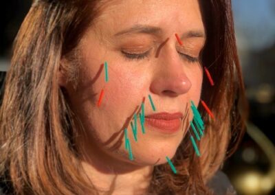 ACUPUNCTURE VISAGE LIFTING ride anti age