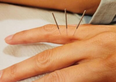 ACUPUNCTURE RENNES AIGUILLE BIEN ETRE STRESS